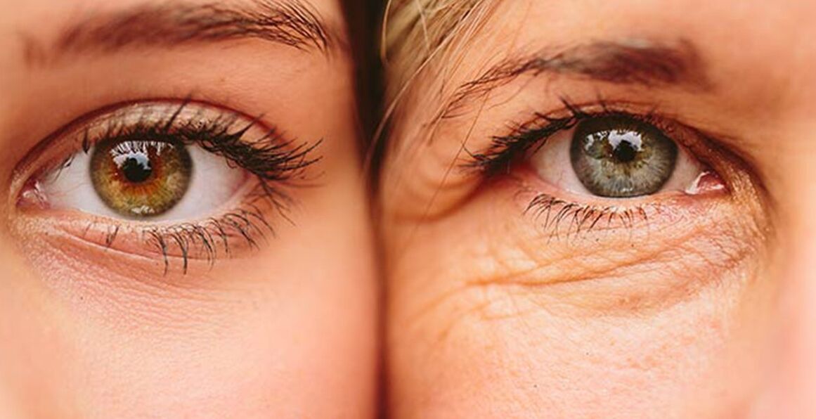 Sinais externos de envelhecimento da pele ao redor dos olhos em duas mulheres de diferentes idades