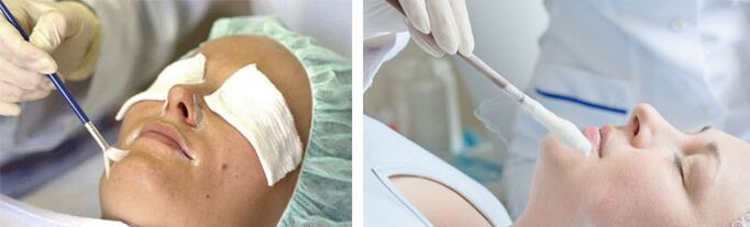 Peeling e crioterapia para rejuvenescimento da pele