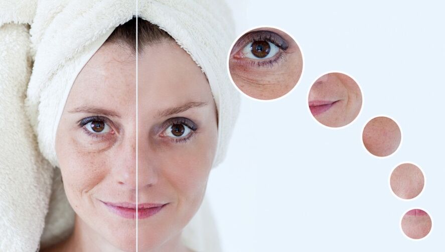 antes e depois do rejuvenescimento da pele com plasma