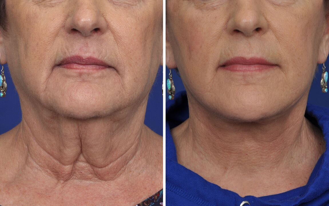 antes e depois de procedimentos de rejuvenescimento da pele