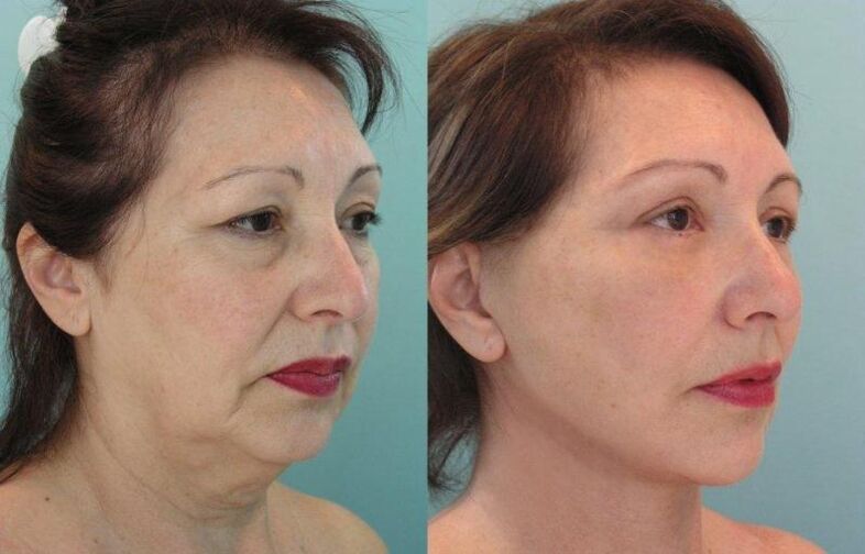 O resultado de um rejuvenescimento da pele facial tensionado com fios