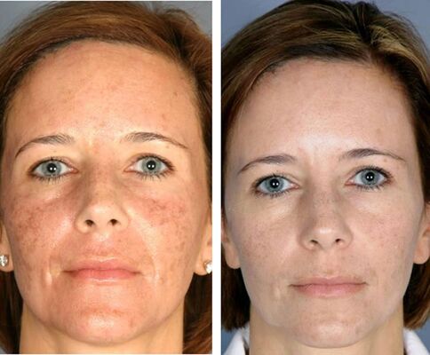 Antes e depois da termólise facial fracionada