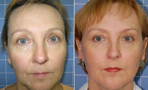 Antes e depois do rejuvenescimento facial a laser fracionado