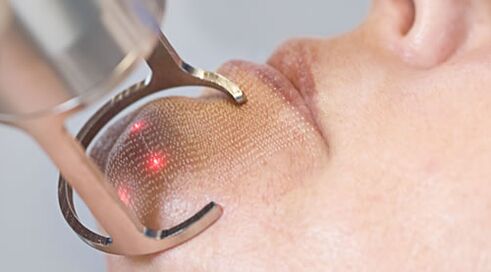 O curso do procedimento para rejuvenescimento da pele facial a laser fracionado